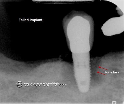 Why do Dental Implants Fail? | Ask Your Dentist