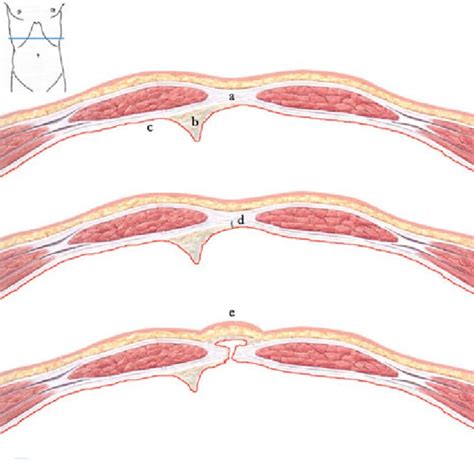 Epigastric Hernia Types