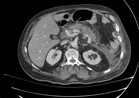 Pancreatitis On CT Scan