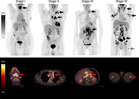 FDG‐PET/CT in the management of lymphomas: current status and future directions - El‐Galaly ...