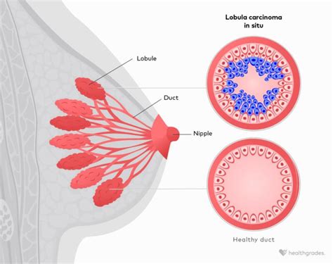 Lobular Carcinoma: Symptoms, Causes, Treatments, and More