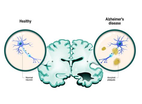 Alzheimer Plaque Affects Different Brain Cells Differently - Research & Development World