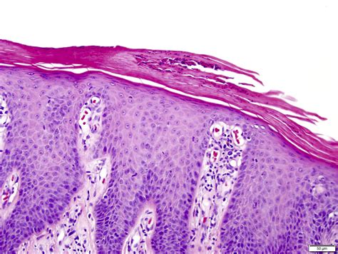 Pathology Outlines - Psoriasis