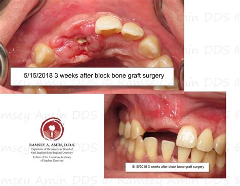 Complication – Bone Graft is Exposed – Platelet PRF Treatment | Ramsey A. Amin, DDS