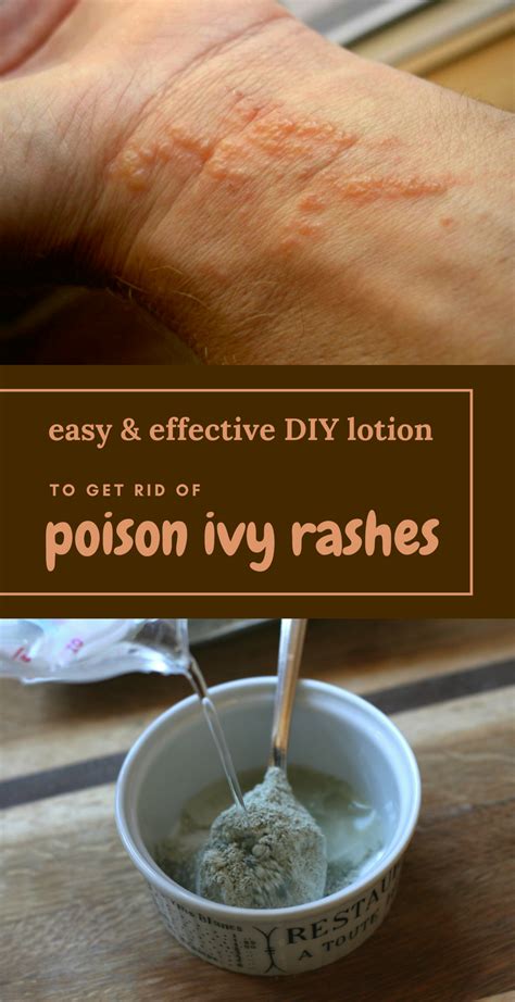 ️ poison ivy rash treatment options – poison ivy rash – Domykinsdy