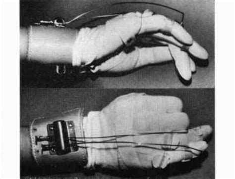 Figure 11. 46-year-old male. Right tardy ulnar | O&P Digital Resource ...