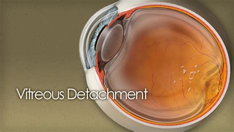 Vitreous detachment (PVD) guide with illustrations & photos