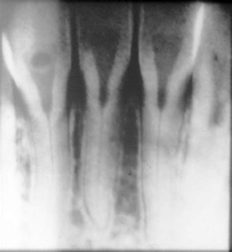 Dentin Dysplasia Type II – Dr. G's Toothpix