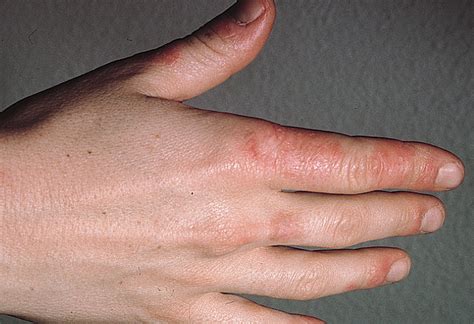 Discoid Lupus Erythematosus–Like Lesions and Stomatitis | Dermatology | JAMA Dermatology | The ...