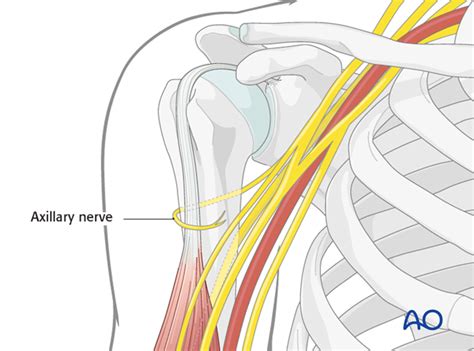 Anterolateral approach to the proximal humerus