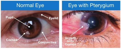 Pterygium - Eye Doctors