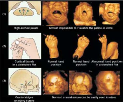 Neonatal signs indicating a prenatal insult (sketch pictures) and ...