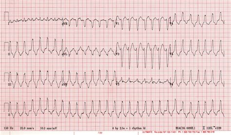 Supraventricular tachycardia (SVT). Causes, symptoms, treatment ...