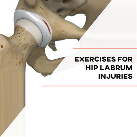 Exercises For Hip Labrum Injuries - [P]rehab