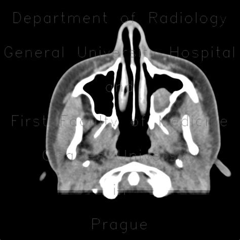 Radiology case: Dentigenous cyst in maxillary sinus, VE