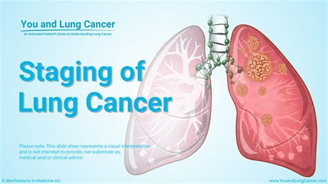 How is non-small cell lung cancer (NSCLC) diagnosed?