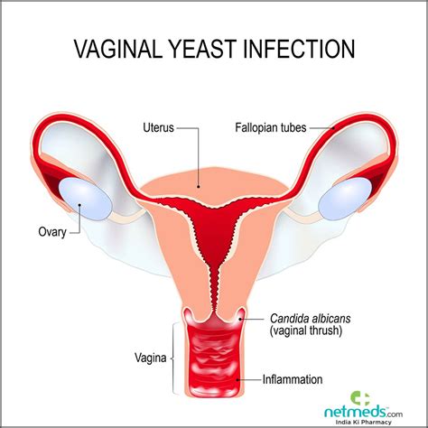 Vaginal Yeast Infection: Causes, Symptoms And Treatment