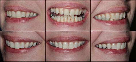 Straighten your Teeth with Invisalign Invisible Braces - Marlborough ...