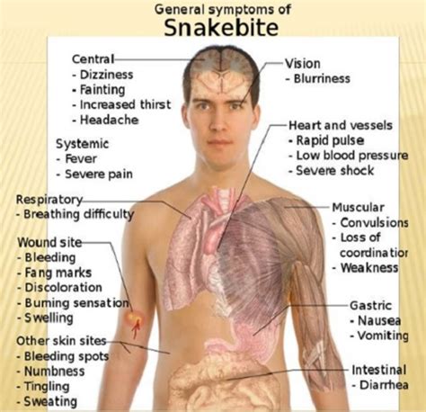 Snakebite