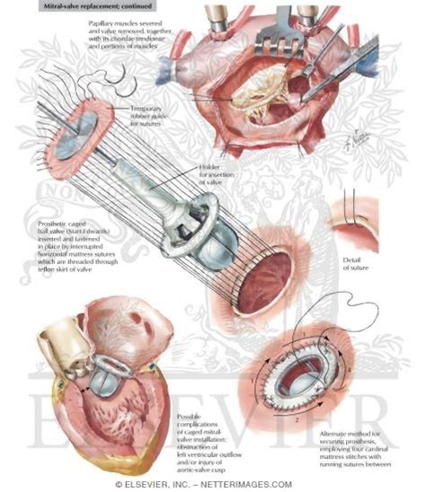 Mitral-Valve Replacement