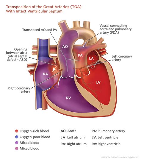 Transposition of the Great Arteries | Children's Hospital of Philadelphia