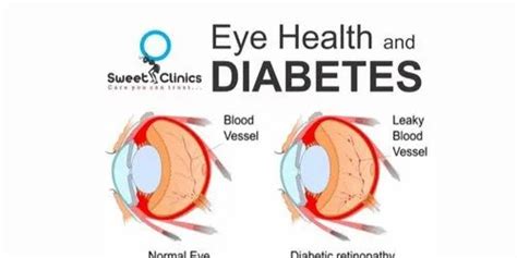 Diabetes Eye Care Treatment at best price in Navi Mumbai | ID: 21149148188