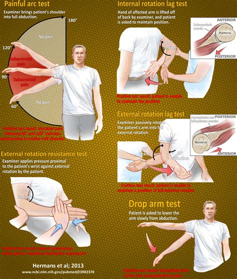 Impingement Syndrome – Back In Action