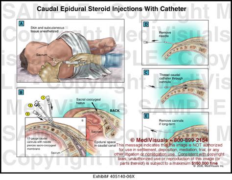 Caudal Epidural Steroid Injections With Catheter Medical Illustration