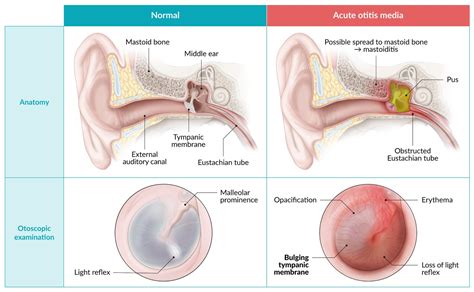 Normal Tympanic Membrane Vs Bulging