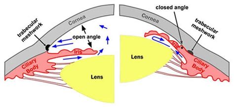 Karl W Whittaker | Consultant Eye Surgeon Types of Glaucoma - Karl W Whittaker | Consultant Eye ...