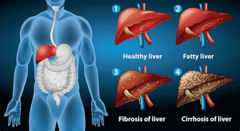 Liver Cirrhosis Causes Symptoms Diagnosis Treatment Medicine My | The ...