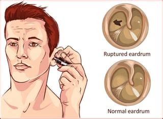 Tympanic Membrane Perforation: Symptoms, Causes, and Treatment Options