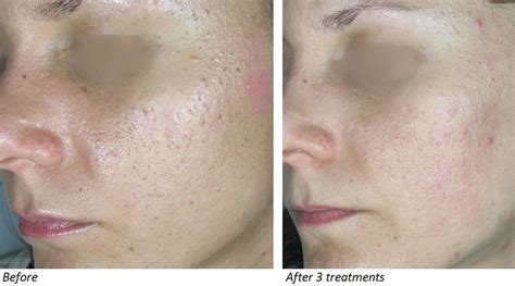 Acne scars laser removal in Birmingham CO2 fractional laser acne scars ...