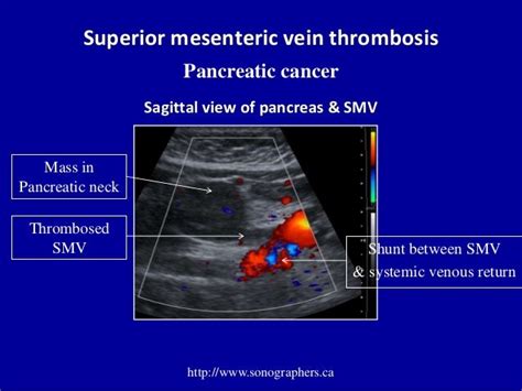 Doppler ultrasound of portal vein thrombosis