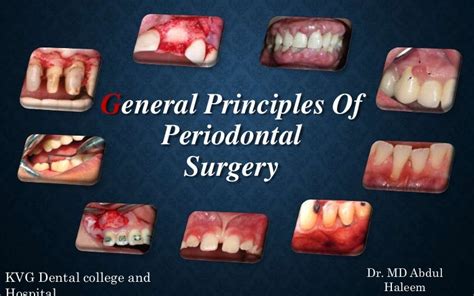 General Principles Of Periodontal Surgery - Riset