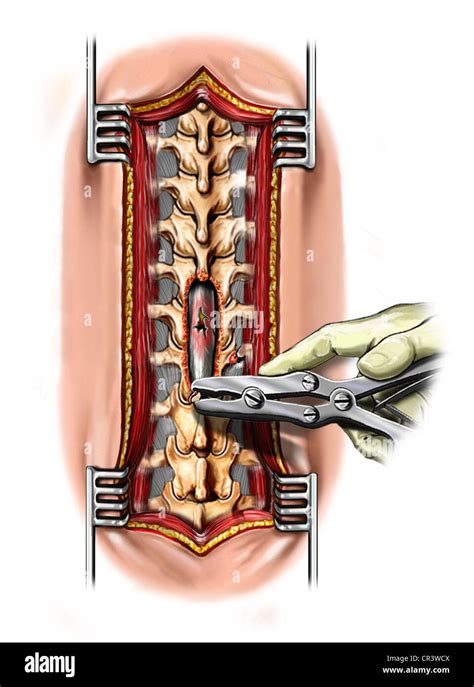 Laminectomy of T11, T12, L1 Stock Photo, Royalty Free Image: 48643642 ...