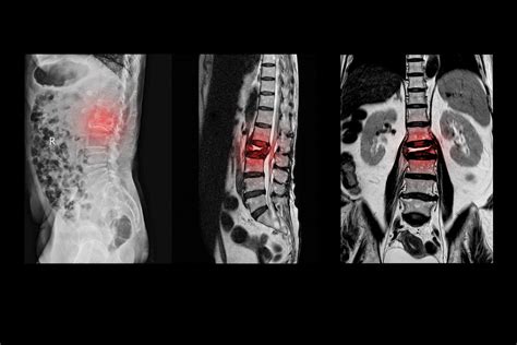 Lumbar Laminectomy Surgery to Cure Spinal Stenosis - Premia Spine