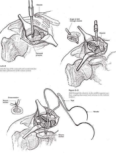 Figure 5−5 from Distal Clavicle Fracture Dislocations | Semantic Scholar