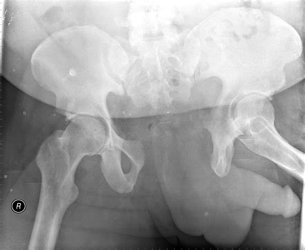 Pelvic Fracture X Ray