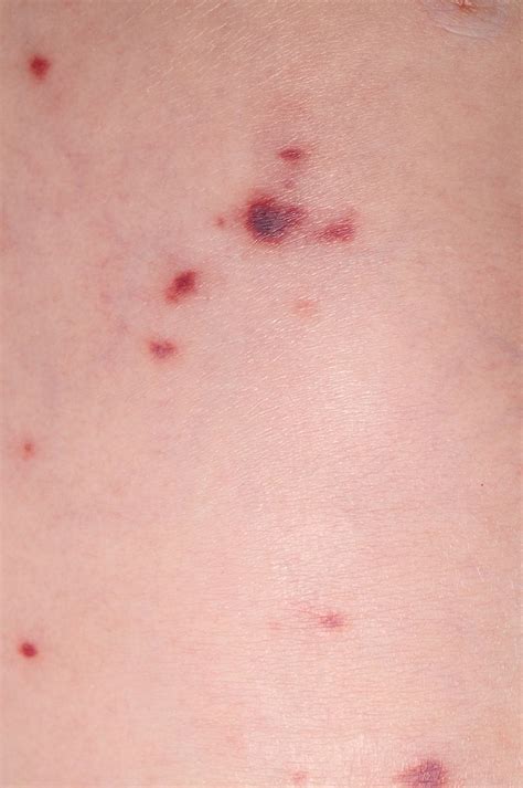 Purpuric and petechial rashes in adults and children: initial assessment | The BMJ