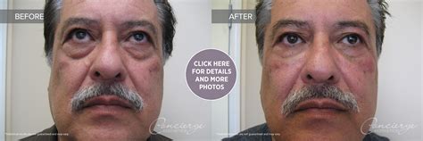 B and A - Juvederm Ultra Under Eyes (64 yo) | Concierge Aesthetics