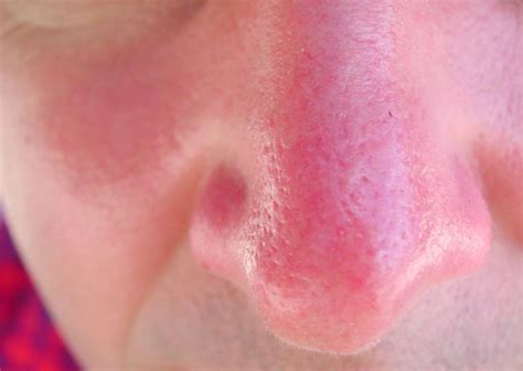 Prevention of a Sunburned Nose and How to Treat It - Skincarederm