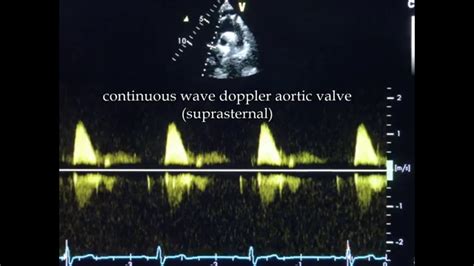 Continuous-wave Doppler - YouTube