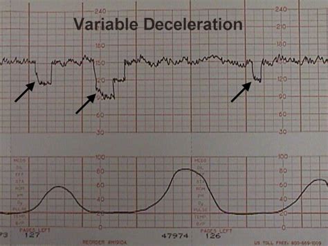 Prolapsed Cord