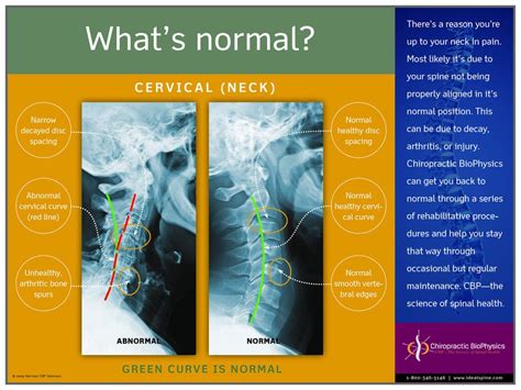 Normal vs. Abnormal Cervical X-Ray – Chiropractic BioPhysics Spinal Arthritis, Disk Herniation ...