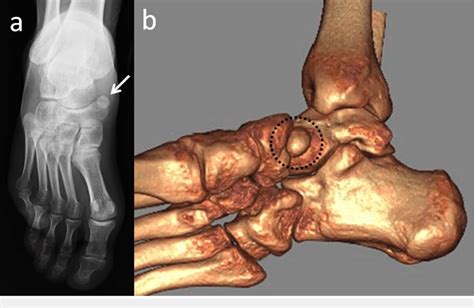 A 47-year-old male patient with an asymptomatic accessory navicular... | Download Scientific Diagram