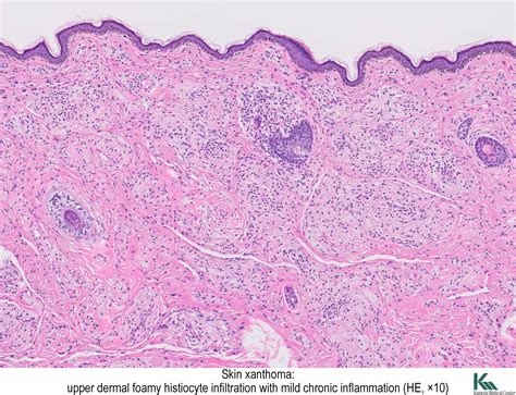 Xanthoma Images.