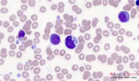 Multiple Myeloma - LearnHaem | Haematology Made Simple