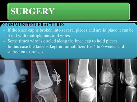 Knee cap (Patella) fractures