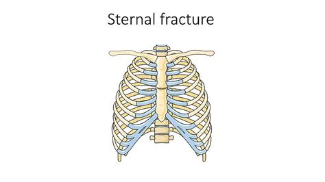 Sternum Fracture Treatment | Sternum Bone Fracture Surgery